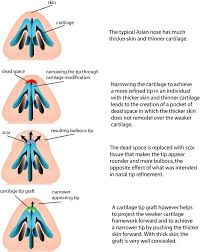 Asian Rhinoplasty Dallas Nose Job Plano Tx Jobs