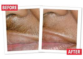 Skincare service in solana beach. Buy Permanent Hair Removal Cream Online Hairfree