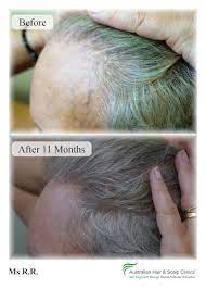 Before fue beard transplant 6 months after beard transplant. Female Hair Loss Androgenetic Alopecia Treatment Female Pattern Baldness Clinics In Melbourne Brisbane