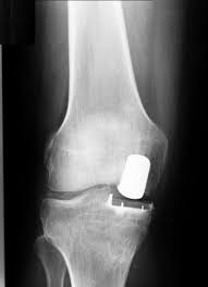 Knieendoprothese Knie Tep Kunstliches Kniegelenk Bei Kniearthrose Gelenk Klinik De