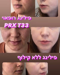 פילינג רפאוי PRX T33