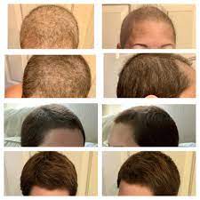 How taxol/paclitaxel kills cancer cells. Stephanie On Twitter Hair Regrowth Dec2019 Mar2020 Losing My Hair To Chemo For 2nd Time After It Was Growing Out Sucks No Lie But It S Slowly Coming Back Again After Taxol Was