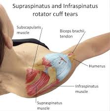 Is Your Shoulder Pain Coming From Your Rotator Cuff Posturepro