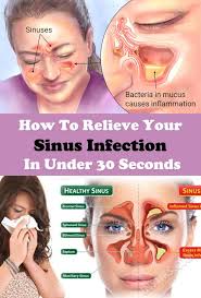 How To Relieve Your Sinus Infection In Under 30 Seconds In 2020 Sinus Headache Home Remedy Sinus Infection Relieve Sinus Headache