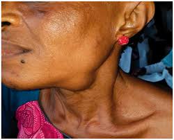 Image result for Sialolithiasis