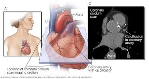 Heart Scan Coronary Calcium Scan Mayo Clinic