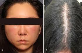 Bd insulin (1 cc) syringes are a good choice, due to lack of leak between syringe and needle. A Permanent Hair Loss In A Patient With Hypersensitivity To Intralesional Triamcinolone Injection