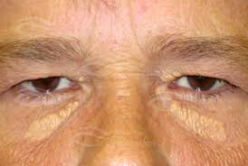 Image result for xantelasma