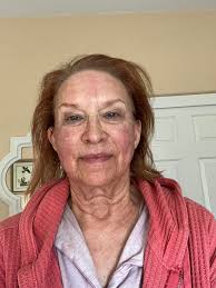 Cool peel treatment results with 1060 co2 laser