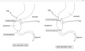 Image result for Intestinal Atresia