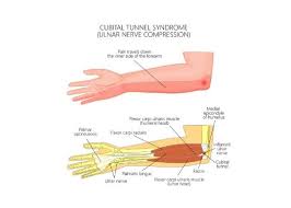 The most common place for ulnar nerve entrapment is on the inside part of your elbow, under a bump of bone known as the medial epicondyle. Ulnar Nerve Entrapment Cubital Tunnel Syndrome Elbow Specialists Boise Meridian Nampa Treasure Valley