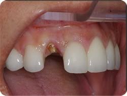 Lawns that become brown, dry, and brittle during peak summer have a way of reviving themselves. When Should You Remove Your Tooth Oceansight Dental Implants