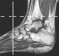 The muscles acting on the foot can be divided into two distinct groups; Plantar Tendons Of The Foot Mr Imaging And Us Radiographics