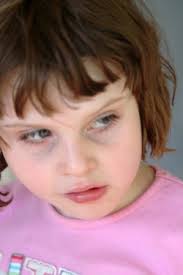 Programs for Severe or Classic Autism