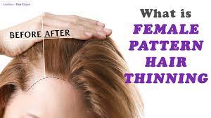 Fphl is related to the predominance of dihydrotestos­terone (dht), which essentially deadens hair follicles and causes hair to fall out. Everything Women Should Know About Female Pattern Hair Thinning Hair Expert Dino Youtube