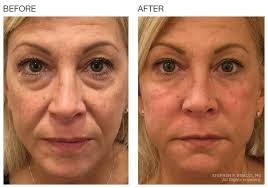 18.10.2021 · whenever receiving a botox treatment, there are a few aftercare instructions to keep in mind. Before After Baselift Lip Art Makeup Botox Cosmetic Cosmetic Treatments