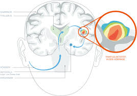 Wirkung Der Tinnitus Therapie Mit Gefilterter Musik