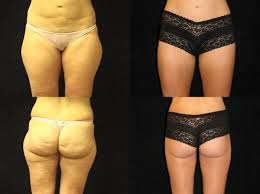 Thighplasty And Lower Body Lift Before And After For More Photos Visit Antonaesthetics Com Body Lift Surgery Lower Body Mommy Makeover Surgery