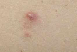 These will hurt because the natural friction. Healthfully Ingrown Hair Ingrown Hair Scar Removal Ingrown Hair Scar