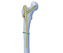 Proximaler Femurnagel Antirotation Pfna