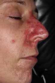 This effect may last for several weeks after you stop using the medicine and is to be expected. Efudix And Me A Photographic Account Of Efudex Follow Up For A Basal Cell Carcinoma Page 4