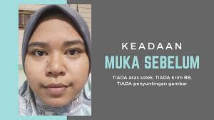 Page 36 of 40 klinik cure and care tampoi johor 37. Klinik Suzana Klinik Pakar Estetik Dan Kulit Di Johor Bharu Apakata Mommy