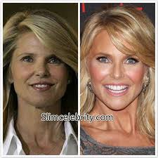 Christie Brinkley Plastic Surgery Before And After Photos Facelift Eyelid Surger Christie Brinkley Plastic Surgery Celebrity Plastic Surgery Cosmetic Surgery