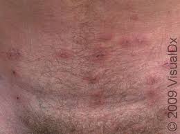 Image result for scabies on genitals