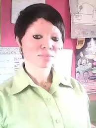 Nigerians with albinism dying of skin cancer due to healthcare gaps