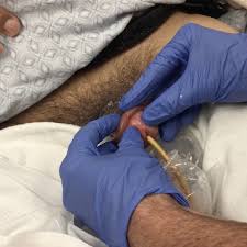 Image result for paraphimosis