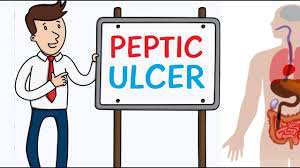 Peptic Ulcer Disease Causes And Treatment Youtube Stomach ulcers often respond well to treatment and sometimes heal within weeks. peptic ulcer disease causes and treatment