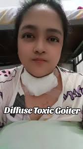 Diffuse Toxic Goiter 🦋 Nag ka Thyroid Storm ako sa Operation 🙏 Thanks God  at naging maayus ang lahat 🙏🙏 #hyperthyroidism #tocixgoiter  #thyroidproblems #totalthyroidectomy #gravesdisease