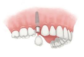 Free dental implants are hard to come by. Dental Implant Cost Guide Unbiased Independent Resource