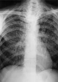 Terabyte (tb), a unit of information (often measuring storage capacity). Extrapulmonale Tuberkulose Infektionskrankheiten Msd Manual Profi Ausgabe