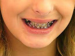Crianca Que Usa Aparelho Perde Menos Dentes Na Vida Adulta Editora Plena