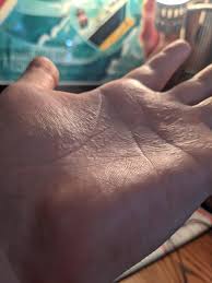 Coupon (1 days ago) zanfel coupons print out.home; One Of My Kids Brought Poison Ivy Into The House Now My Hands Look Like This Every Bump Is A Blister Wellthatsucks