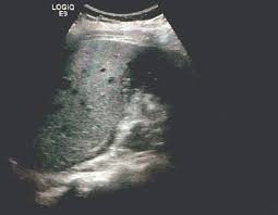 The Red Flags Of Impending Gallbladder Rupture Emergency Physicians Monthly