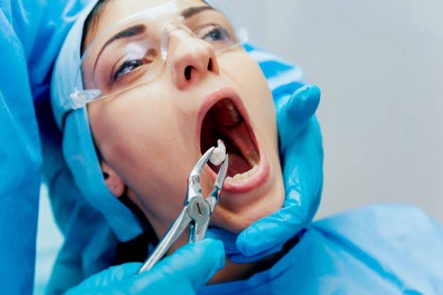 Wisdom Tooth Removal Treatment in Sus, Pune product image