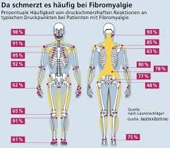 Tender Points Bei Fibromyalgie Fibromyalgie Fibromyalgie Symptome Fibromyalgie Ernahrung