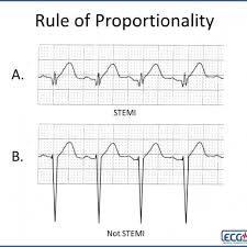 St depression ≥ 2 mm in ≥ 3 leads is associated with a high probability of nstemi and predicts significant mortality (35% mortality at 30 days). What Is A Stemi Ecg Medical Training