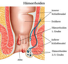 Sie können jedoch unangenehme symptome hervorrufen, welche die lebensqualität beeinträchtigen. Hamorrhoiden Ursachen Symptome Behandlung
