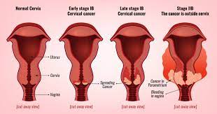 Stage 1 cervical cancer is limited to the cervix. Cervical Cancer Stages Prof Andreas Obermair Professor Andreas Obermair