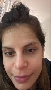 Permanent under eye fillers alternatives?