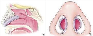 Image result for Nasal Packing