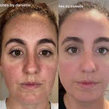 Sarah McKibbin|Dermal Therapist