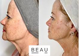 The proof is in the glow! Morpheus8 delivers stunning results that speak  volumes. With cutting edge technology and expertise, your skin is a few  appointments away from its full potential! Morpheus8 treats