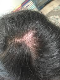 Im 21 Years Old Is This A Bald Spot I Have Long Hair And Im Hoping That This Part Of My Hair Isnt A Result Of That If Bald Spots Women
