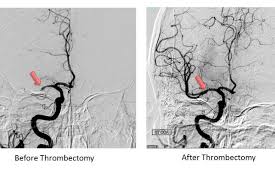 The chance of developing a permanent stroke (weakness, numbness or paralysis) as the result of a cerebral angiogram is approximately 0.5%. Time Window To Help People Who Ve Had A Stroke Longer Than Previously Shown Ucla