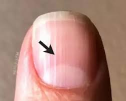 Do You See These Strange Lines On Your Nails Don T Joke With It This Is What It Says Of Your Health As Ive Gotten Older T In 2020 You Nailed It