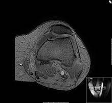 Chondropathia Patellae Wikipedia